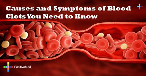 Can Running Cause Blood Clots? Exploring the Paradox of Movement and Stasis